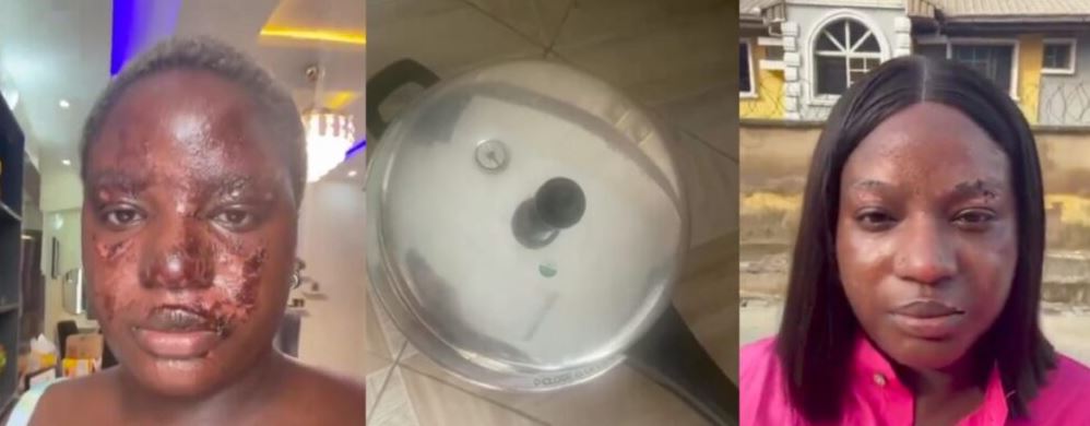 Nigerian Lady Narrates Terrifying Experience Where A Pressure Pot Nearly Took Her Sight (Video)