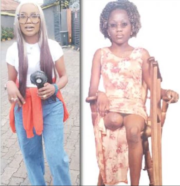 How I Became An Amputee Two Days After My Birthday – Nigerian Businesswoman Tells Her Story