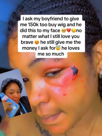 Lady Shares What Boyfriend Did To Her Face After She Requested N150K For Wig (Video)