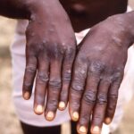 Nigeria Records 39 Cases Of Mpox