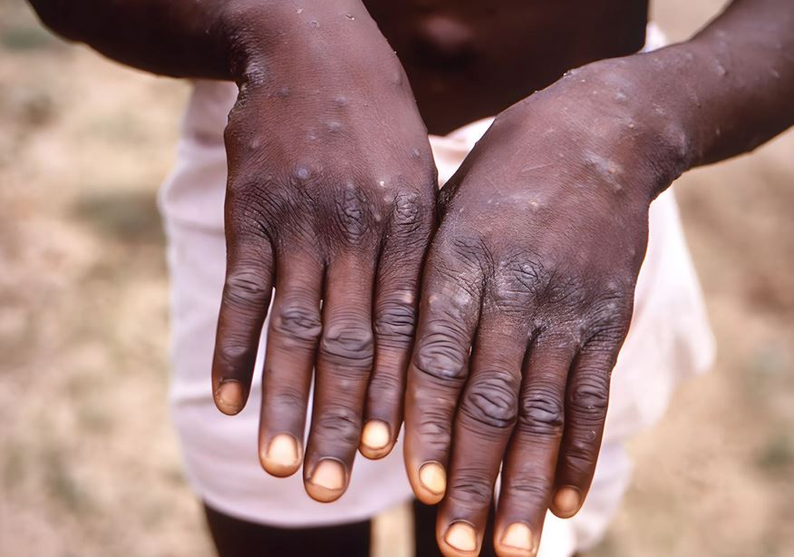 Nigeria Records 39 Cases Of Mpox