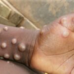 ECOWAS Raises The Alarm As Mpox Spreads In Africa