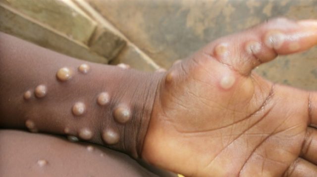 ECOWAS Raises The Alarm As Mpox Spreads In Africa