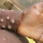 Monkeypox Spreads To 19 Nigerian States