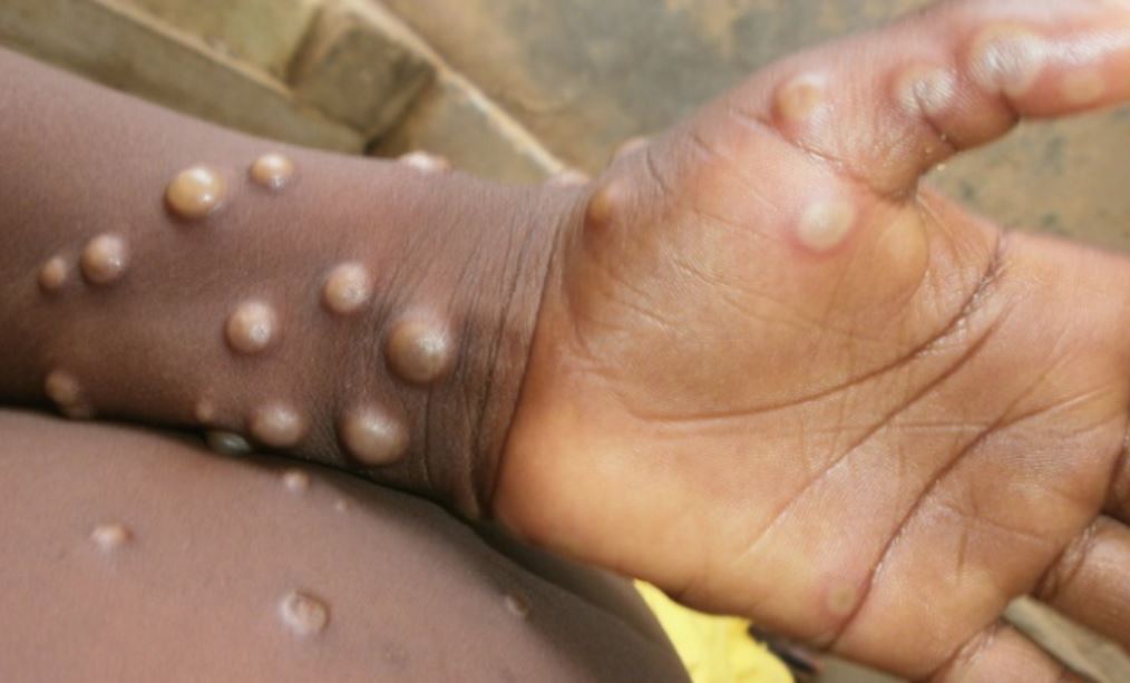 Monkeypox Spreads To 19 Nigerian States