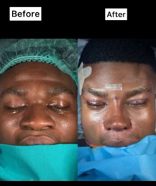 My Dream Nose – Nigerian Comedian, Zicsaloma Undergoes Nose Surgery In Turkey (Video)